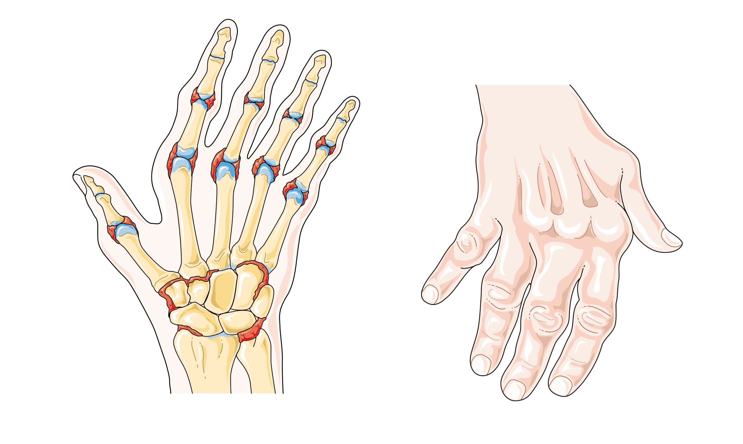 Rheumatoid arthritis is an autoimmune disease that causes the immune system to attack healthy cells of the body, primarily affecting joints resulting in painful inflammation.