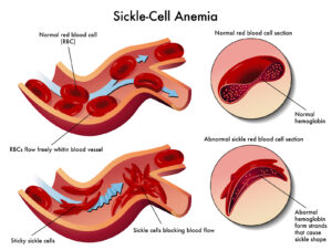 Sickle cell anemia is part of a group of genetic disorders known as sickle cell disease. In those with sickle cell anemia, red blood cells, which are usually round, flexible and flow easily within blood vessels, are sickle-shaped and lead to blockages to blood flow. This sickle shape is caused by an abnormal form of hemoglobin, a protein responsible for carrying oxygen. As a result, less oxygen is delivered to organs of the body, leading to severe consequences, including hypoxic organ damage and increased risk of stroke.