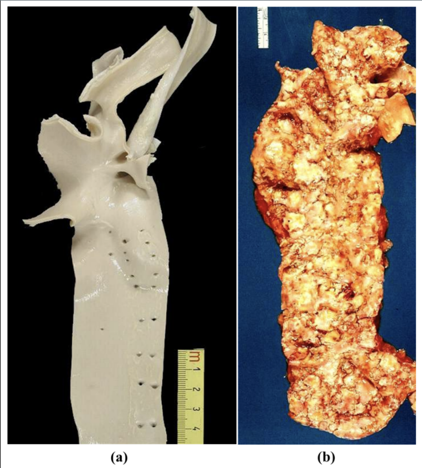(a) Normal thoracic aorta in a child; (b) Severe atherosclerosis of the aorta in an old man.