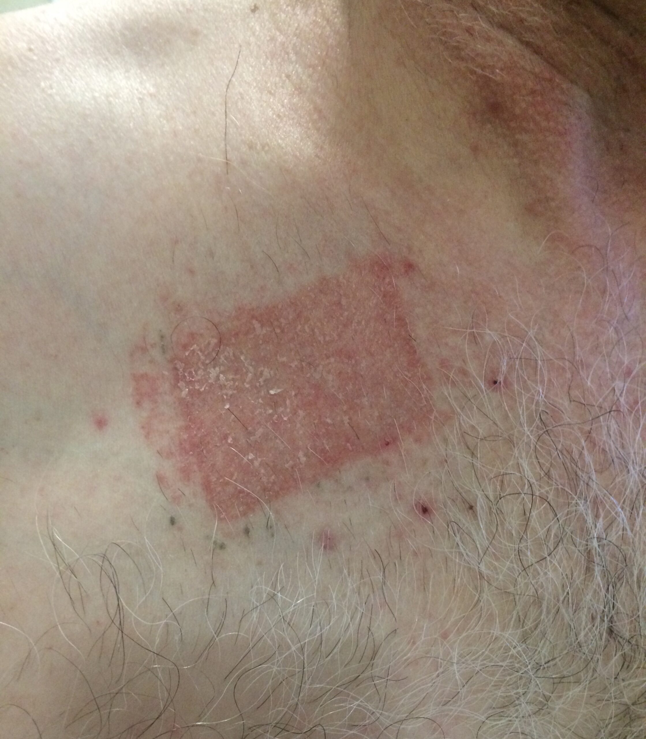 Patient with severe contact dermatitis at the application site of a 15mcg/hr buprenorphine transdermal (Norspan) patch.