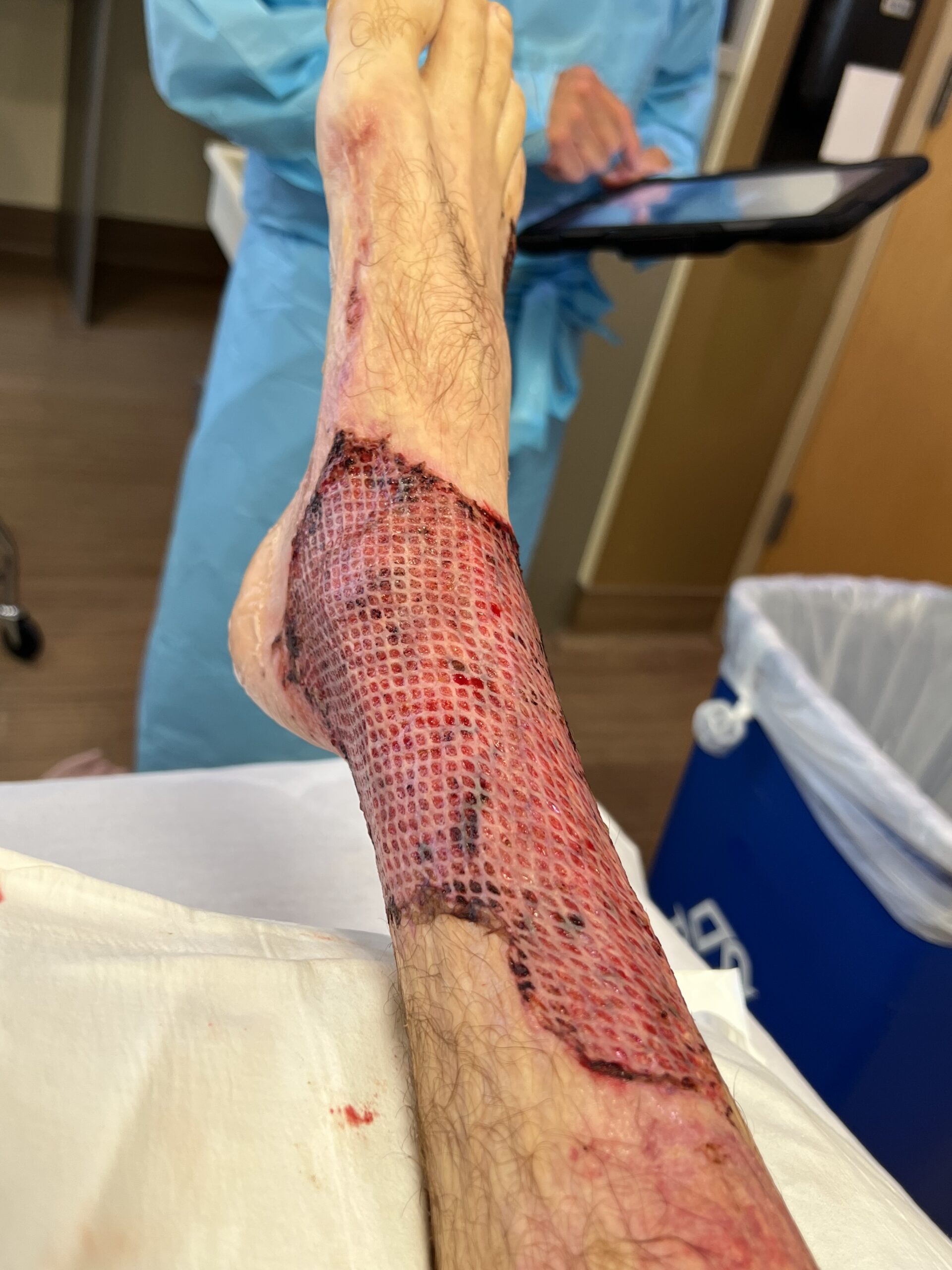 Skin graft performed on the ankle due to third degree burns.