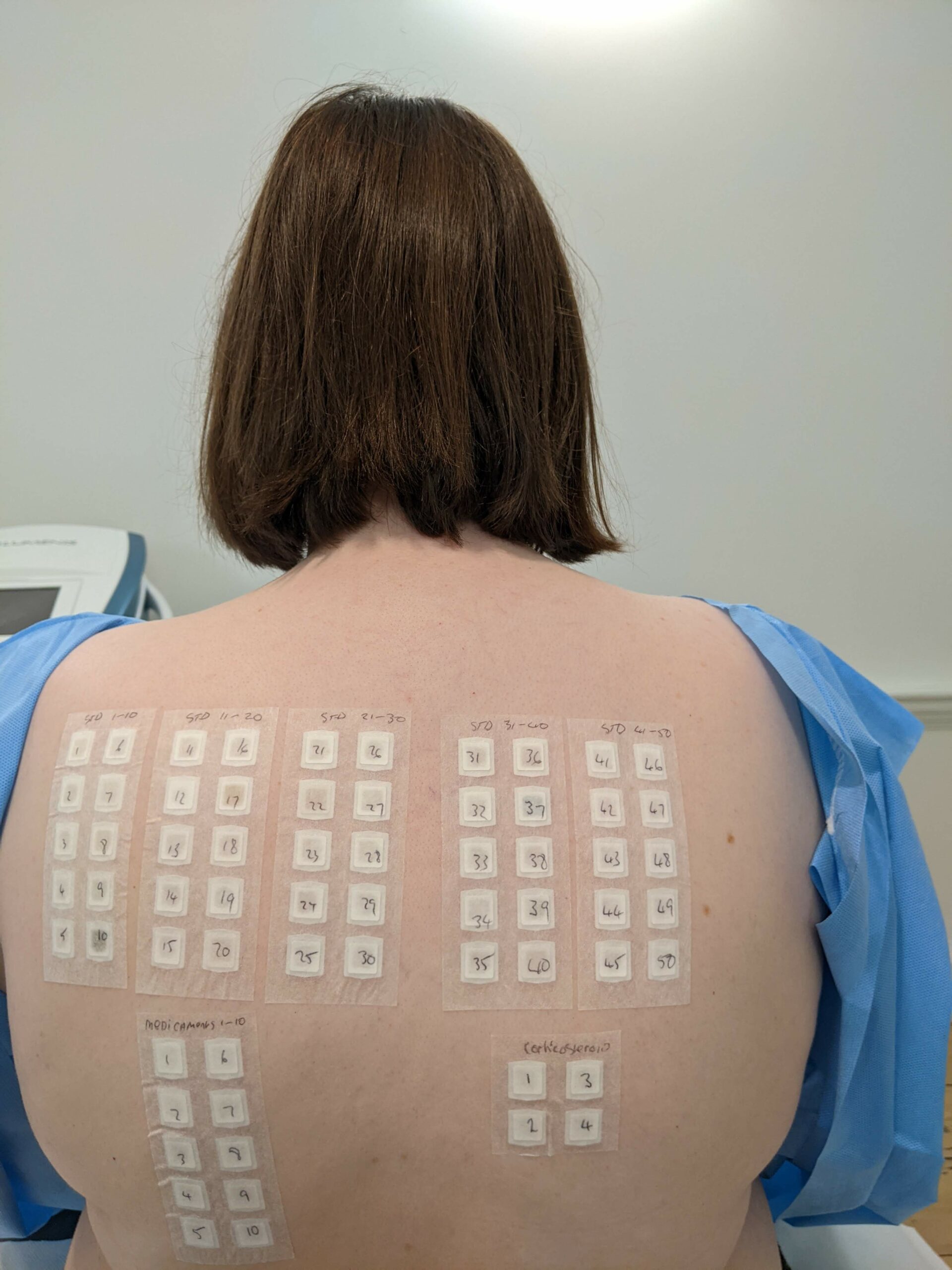 Skin patch allergy test on the back of a patient.