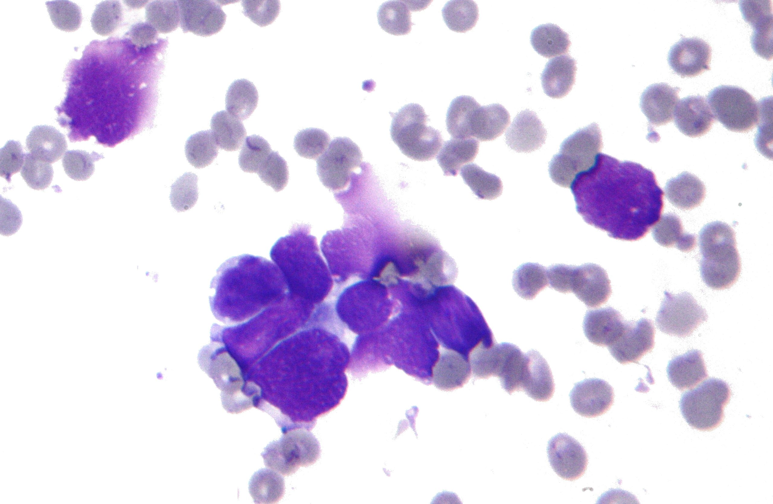 Example of carcinoma