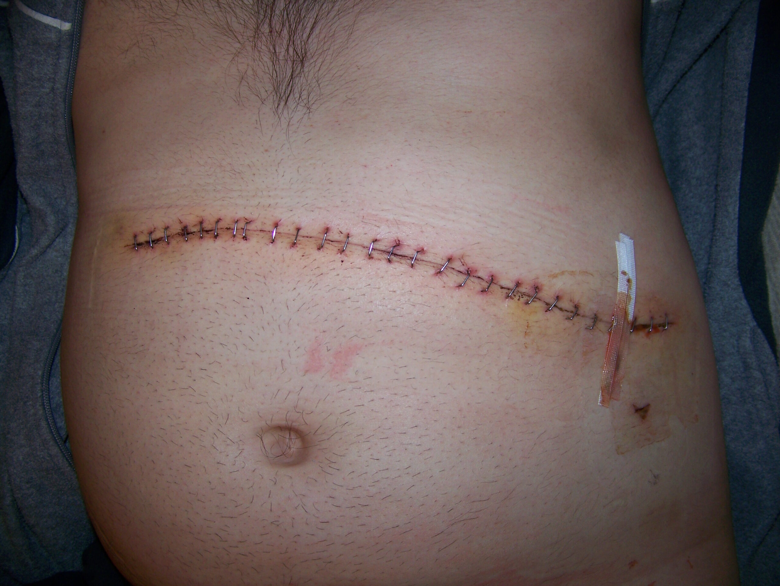 Scar following splenectomy. This procedure partially or completely removes the spleen, an organ important for immunological function.