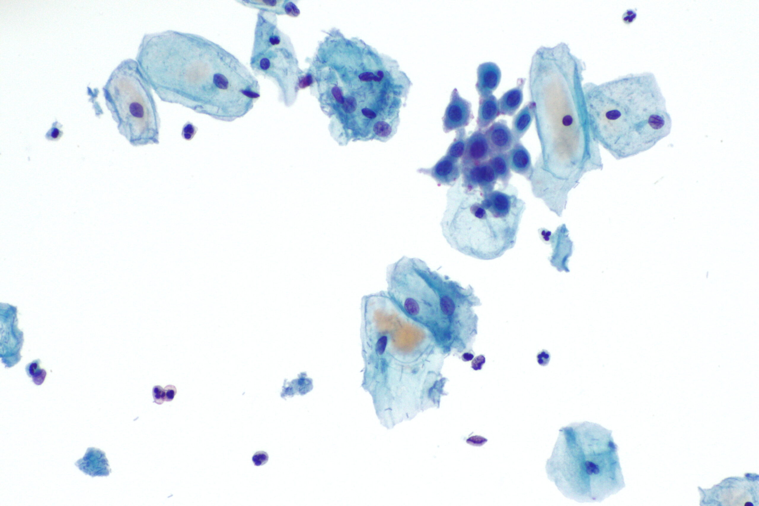 Example of metaplasia