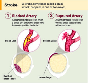 Figure 1. A stroke, sometimes called a brain attack, happens in one of two ways: 1) ischemic strokes occur when an artery is blocked, and 2) hemorrhagic stroke occurs when a blood vessel ruptures.