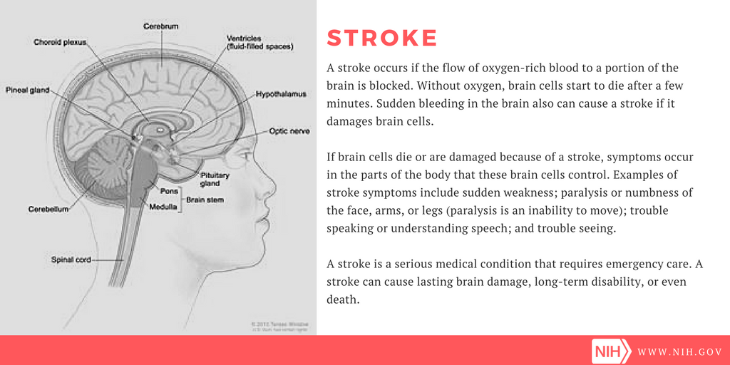 Stroke definition & symptoms.