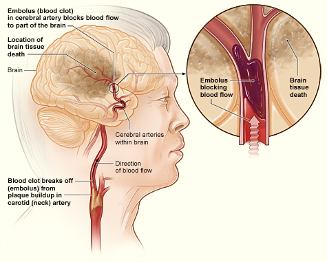 Ischemic Stroke.