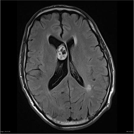 MRI - WHO grade I ependymoma