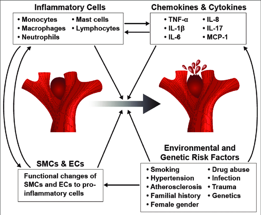 Summary of the factors contributing to cerebral aneurysm pathogenesis. Inflammatory cells, cytokines, chemokines, changes to the vascular smooth muscle cells and endothelial cells, and environmental as well as genetic risk factors all play a role in the development of cerebral aneurysms and their progression to rupture.