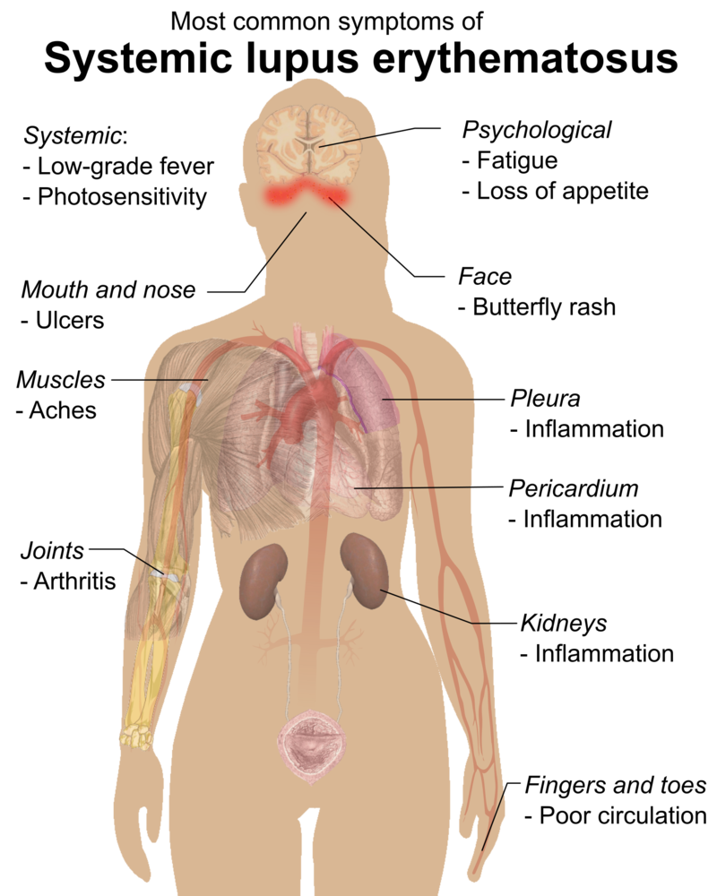 Systemic lupus erythematosus (SLE) is an autoimmune disease where the immune system attacks its own healthy body tissues, causing widespread inflammation in affected organs.