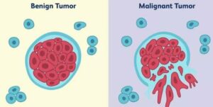 The benign tumors are often encapsulated and don't metastasize and are not considered cancerous. Malignant tumors usually lack a capsule and are cancerous, capable of invading surrounding tissues and metastasizing.