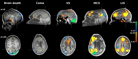 Brain Connectivity in Pathological and Pharmacological Coma