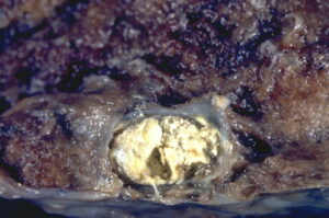 Example of caseous necrosis.