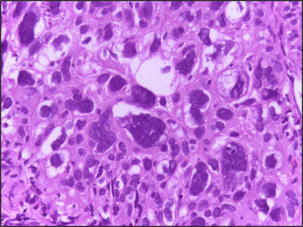 Example of anaplasia