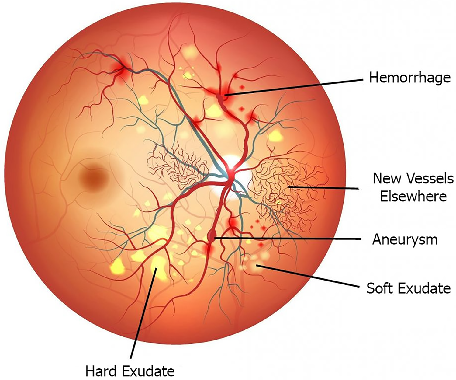 Hemorrhage in retina