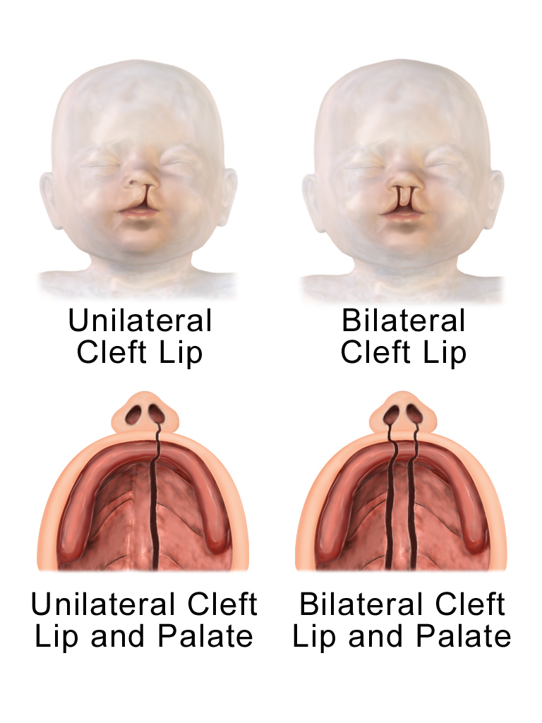 Example of a congenital multifactorial defect: cleft lip and cleft palate.