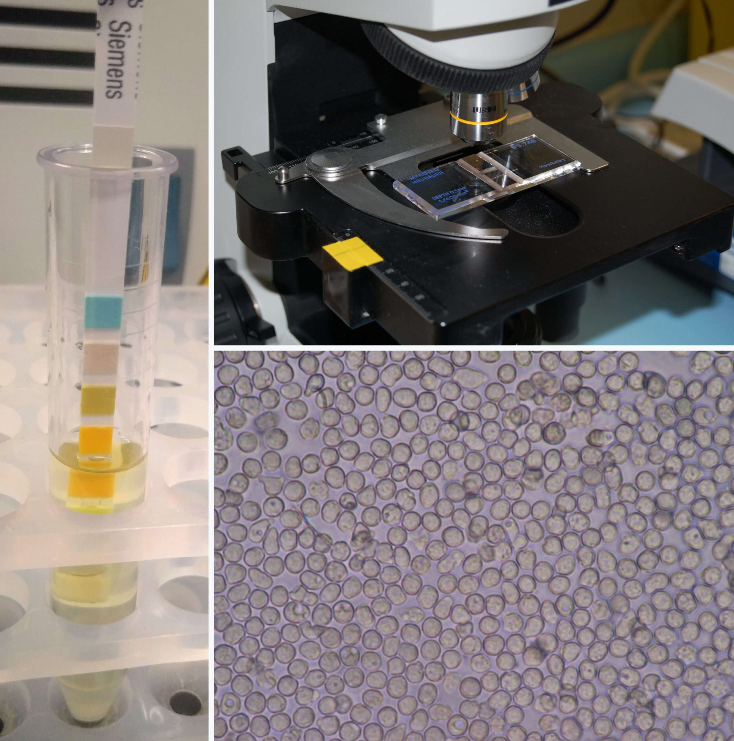 The procedure of urinalysis. Left: A urine test strip is immersed into the sample. Top right: A urine sample is about to be examined under a phase-contrast microscope using a Neubauer counting chamber. The urine is under the cover slide, in the upper segment formed by the H-shaped grooves. Bottom right: Phase-contrast microscopic image showing many white blood cells in the urine (pyuria).