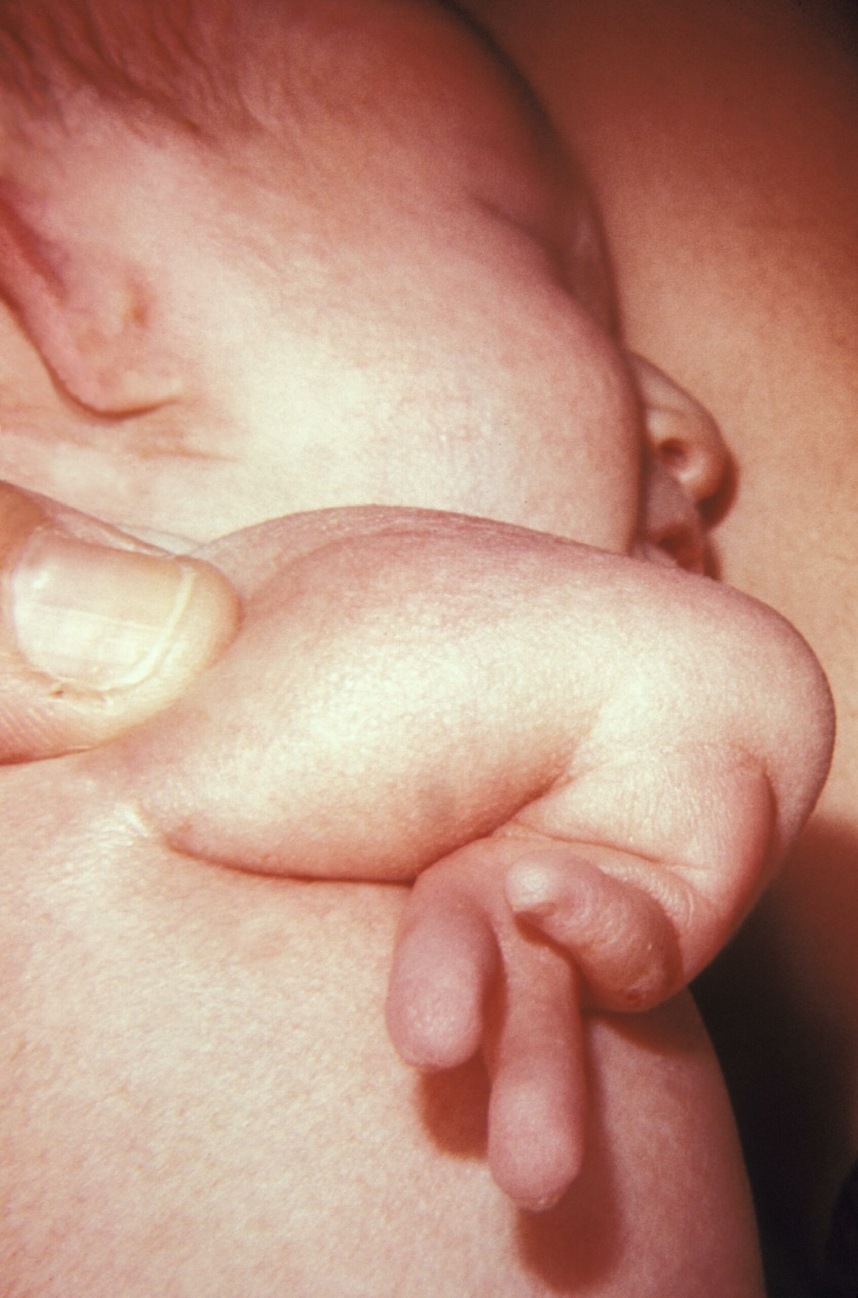 Example of congenital multifactorial defect: radial aplasia (limb defect).