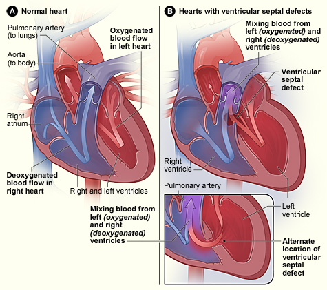 congenital heart defect