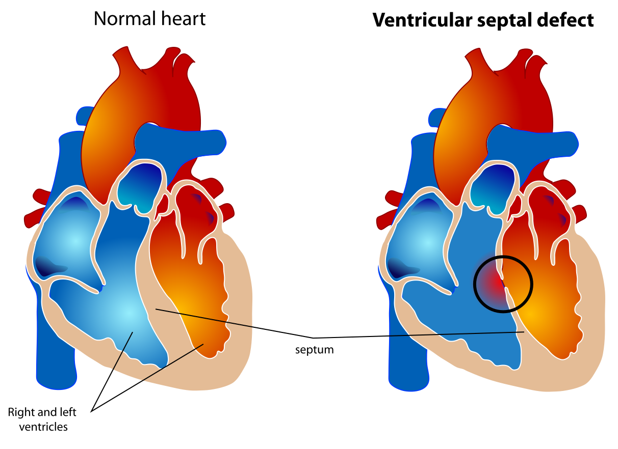 Ventricular septal defect