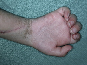 Volkmann Contracture