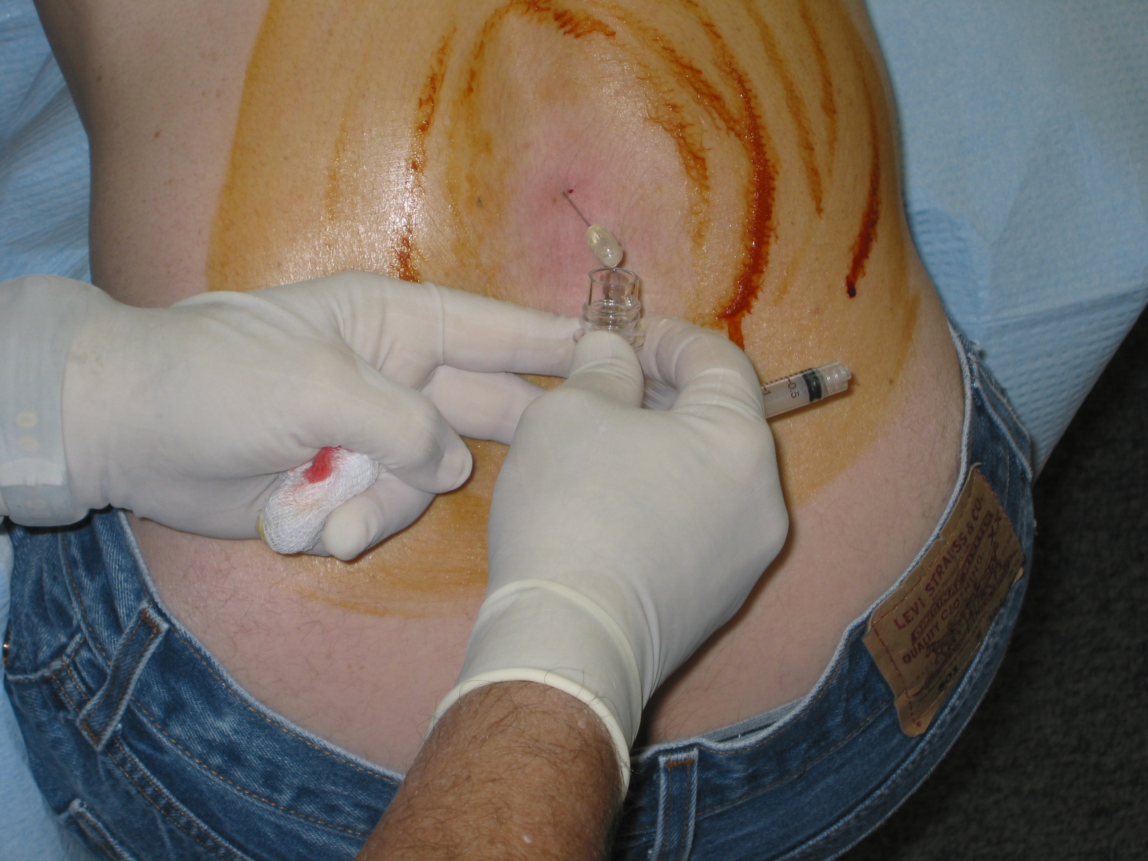 Wikipedian getting a lumbar puncture (2006).