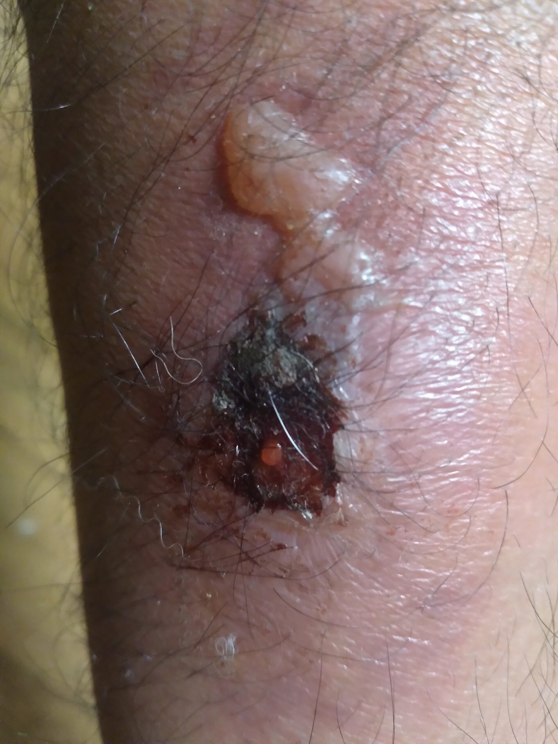Wound caused by bacterial infections present deep within the skin.