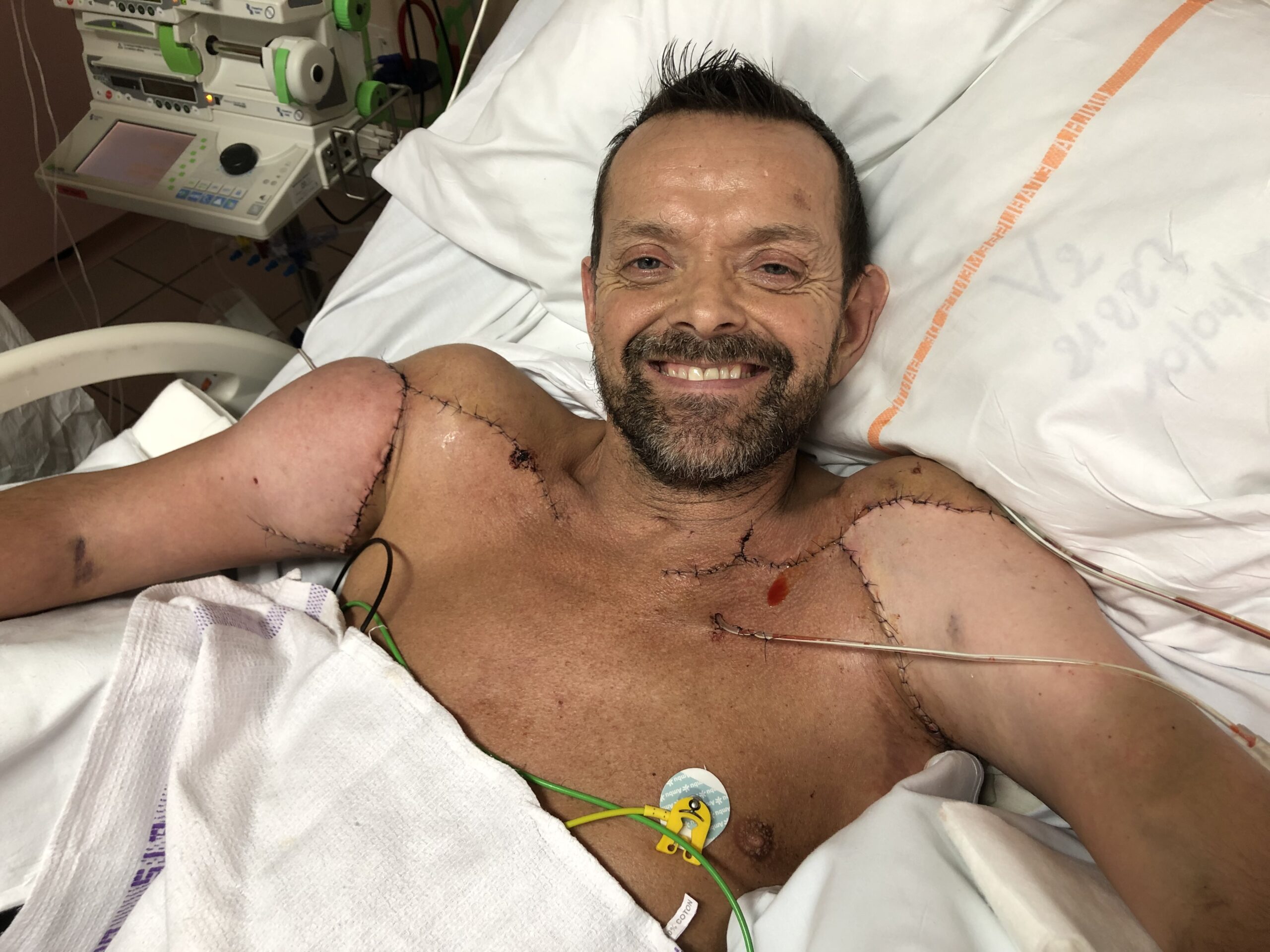 Felix Grétarsson received a double-arm and shoulder transplant at Edouard Herriot Hospital in Lyon, France in January 2021. This is an example of an allograft, a transplant of tissue from a non-genetically identical donor of the same species.