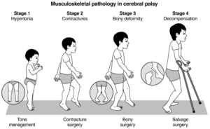 The stages of musculoskeletal pathology (MSP) in children with spastic cerebral palsy, from birth to skeletal maturity. Note the overlapping age ranges, and that features of Stage 2 and 3 usually occur together.