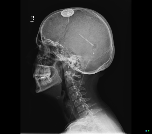 Wireless intracranial pressure monitor.