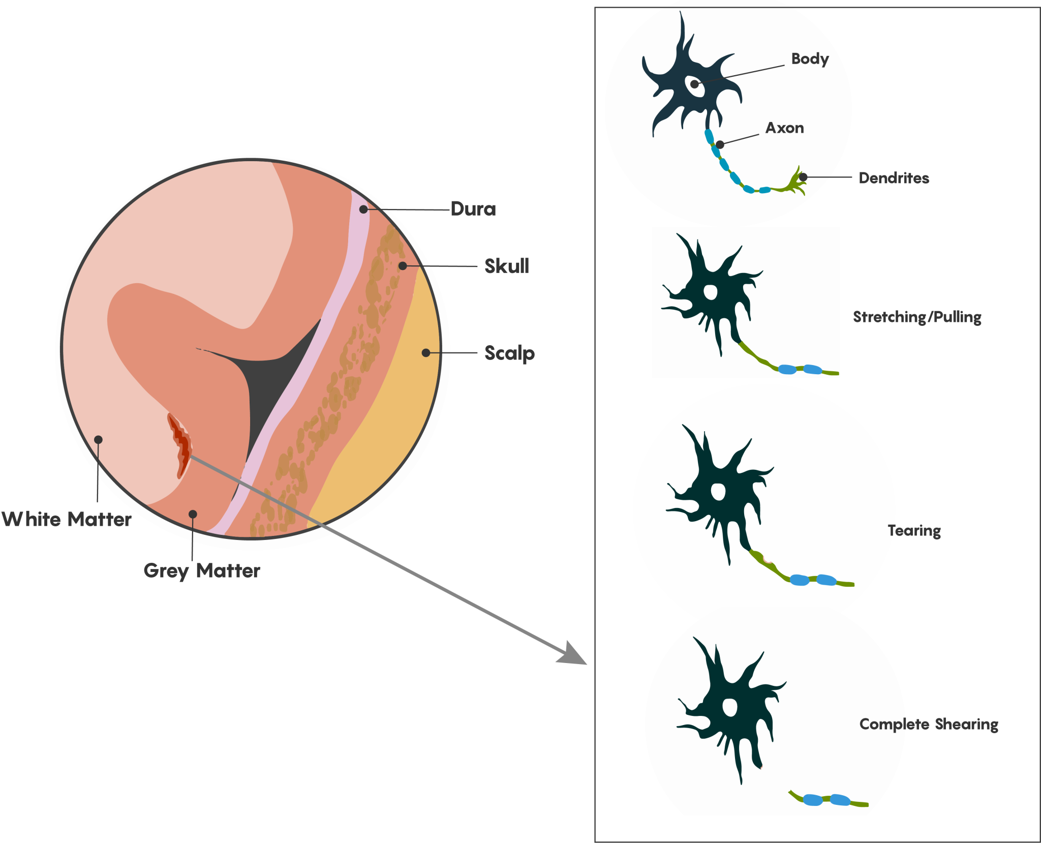 Figure 5. Diagram of diffuse axonal injury following TBI/concussion. Many types of damage can occur along the length of the axon, including stretching/pulling of axons which may affect myelination and localization of axonal channel proteins, and tearing and shearing, which will cause loss of axonal integrity.