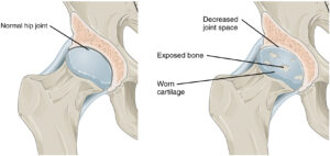 Osteoarthritis of a synovial joint results from aging or prolonged joint wear and tear. These cause erosion and loss of the articular cartilage covering the surfaces of the bones, resulting in inflammation that causes joint stiffness, joint narrowing, and pain.