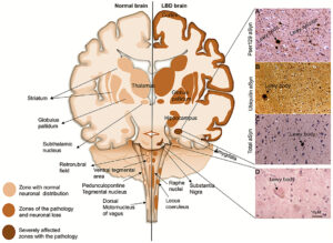 Coronal schematic of the brain, depicting normal structures and in LBD subjects.