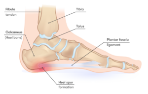 Medical illustration of the bones of a human foot, showing the formation of a heel spur.