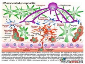 HIV associated encephalitis.