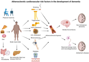 Proposed pathways from atherosclerotic cardiovascular risk factors for dementia to the development of disease.
