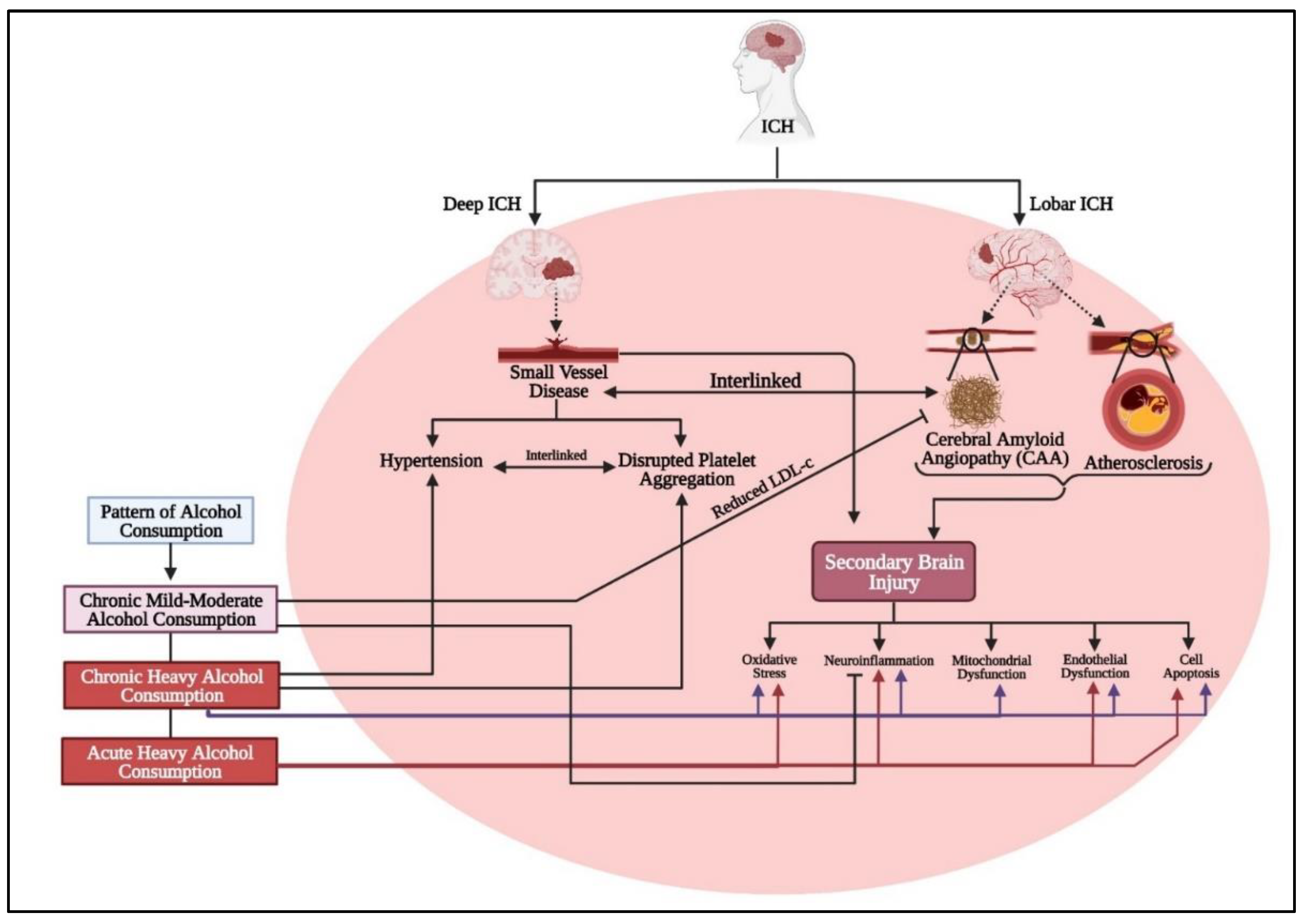Figure 4. Alcohol consumption, categorized as chronic mild–moderate, chronic heavy, or acute heavy (binge drinking), has varying impacts on ICH. ICH is divided into deep ICH, primarily caused by small vessel disease due to hypertension and platelet dysfunction as well as lobar ICH, influenced by cerebral amyloid angiopathy (CAA) and atherosclerosis. Both types involve SBI mechanisms like oxidative stress, neuroinflammation, mitochondrial dysfunction, endothelial dysfunction, and cell apoptosis. Chronic heavy alcohol consumption exacerbates all these SBI mechanisms. Acute heavy consumption contributes to oxidative stress, neuroinflammation, endothelial dysfunction, and apoptosis but not mitochondrial dysfunction. In contrast, chronic mild–moderate consumption can be protective, reducing neuroinflammation and CAA by lowering low-density lipoprotein-cholesterol (LDL-c).