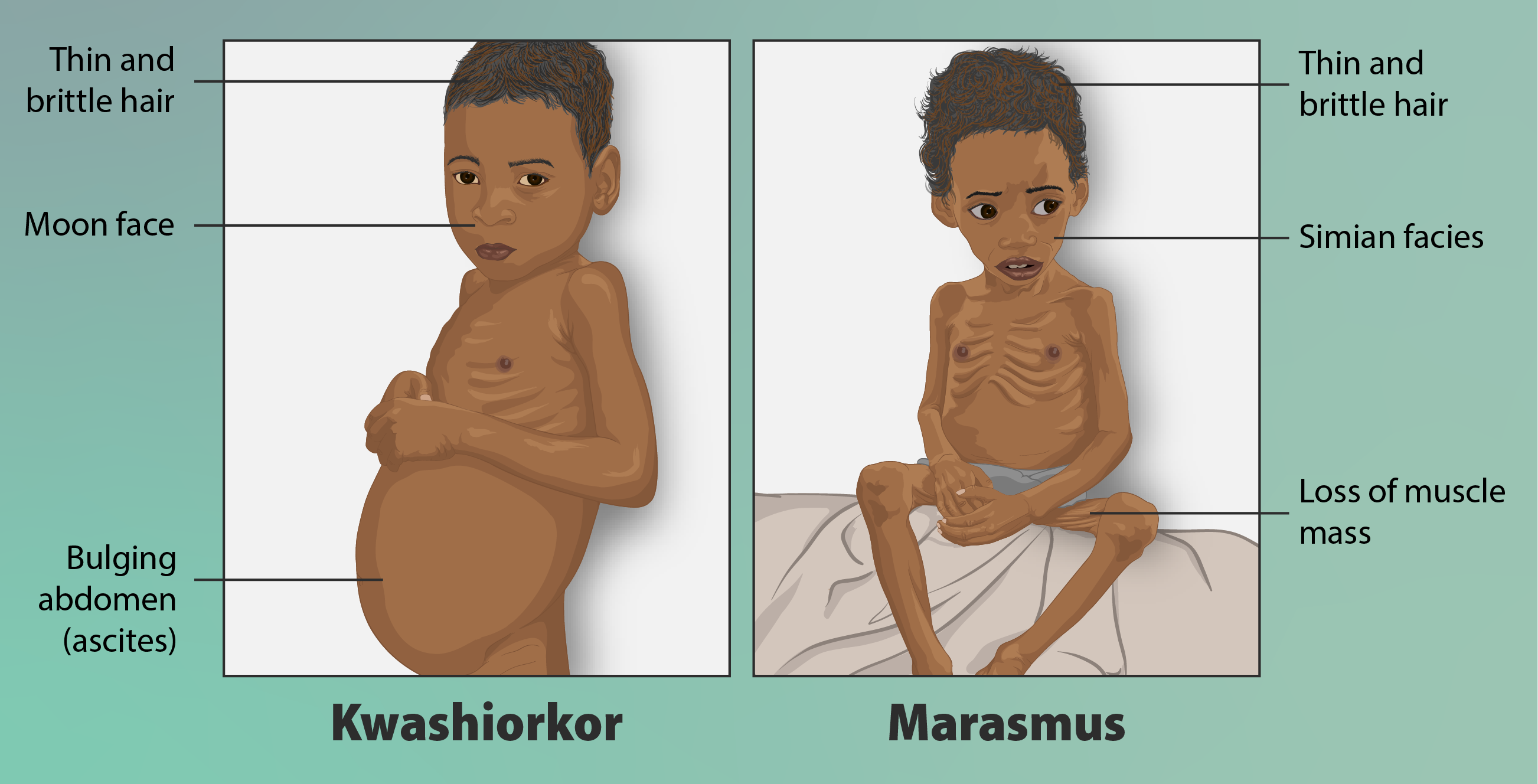 Malnutrition is a suite of conditions that consist of inadequate, imbalance, or excess energy and/or nutrient consumption. Kwashiorkor malnutrition is defined by severe protein deficiency, while marasmus malnutrition is marked by a deficiency in all macronutrients. However, obesity, an excess in energy and nutrient consumption, is also considered to be a form of malnutrition.