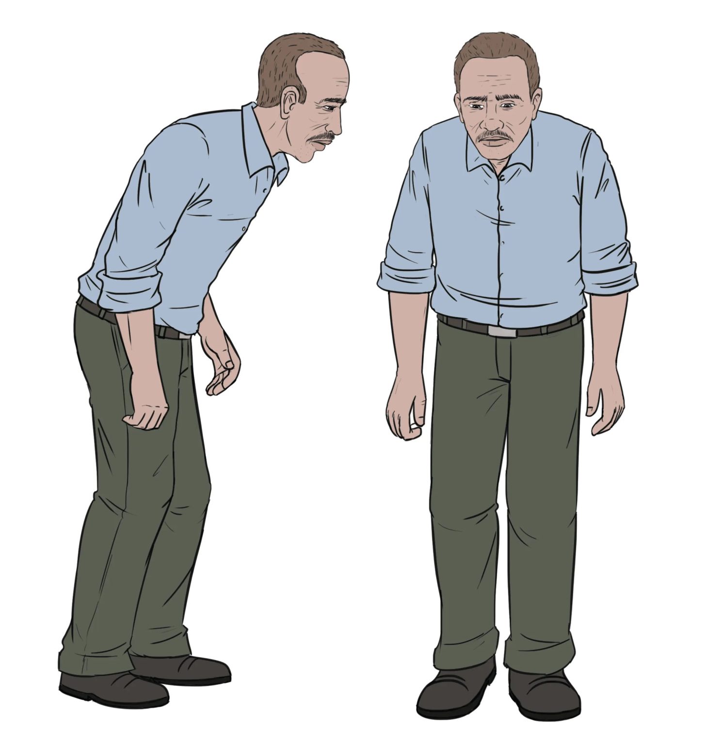 Figure 13. Parkinson’s patients often have a characteristic hunched posture and walk with slow, shuffling steps. People with Parkinson’s also have an elevated fall risk.