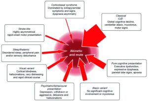 Creutzfeldt-Jakob disease (CJD) clinical features and progression. The boxes describe clinical variants of CJD. The width of each arrow relates to the proportion of cases with the presentation. Patients with CJD become more similar over time, and almost all enter a phase of ‘akinetic mutism’ before death.