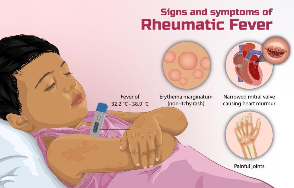 Rheumatic fever is characterized by inflammation, primarily of the heart, joints, skin, and brain. It is an immune response following a previous infection.