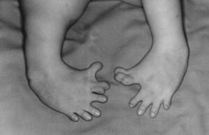 Congenital malformation of the feet due to exposure to thalidomide, a potent teratogen, during pregnancy.