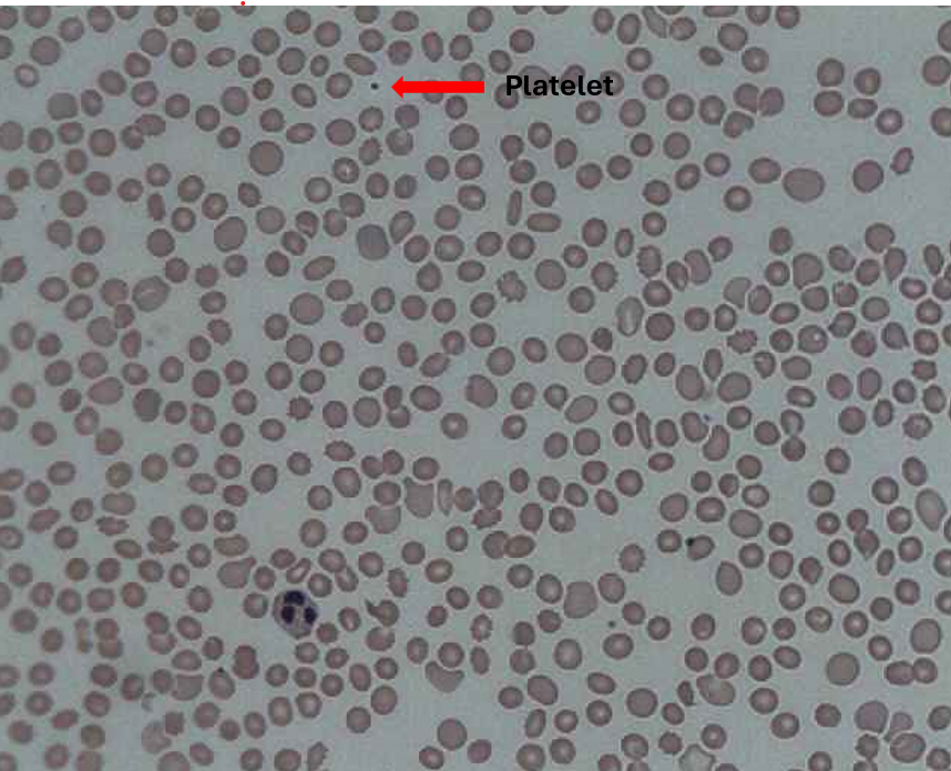 Peripheral blood smear indicating thrombocytopenia (low platelet count).