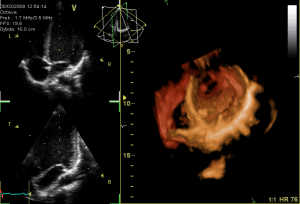GIF-animation showing a moving echocardiogram; a 3D-loop of a heart viewed from the apex, with the apical part of the ventricles removed and the mitral valve clearly visible. Due to missing data the leaflet of the tricuspid and aortic valve is not clearly visible, but the openings are. To the left are two standard two-dimensional views taken from the 3D dataset showing the opening and closing of both left and right atrioventricular valves.