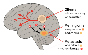 Brain Cancers can cause many problems including compression, edema, increased Intracranial Pressure (ICP), and permanent neuron damage.