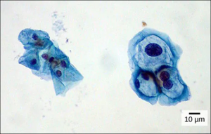 Normal and HPV-infected Cervical Cells: These uterine cervix cells, viewed through a light microscope, are from a Pap smear. Normal cells are on the left. The cells on the right are infected with human papillomavirus (HPV). Notice that the infected cells are larger. Also, two of these cells each have two nuclei instead of one, the normal number. (credit: modification of work by Ed Uthman, MD; scale-bar data from Matt Russell)