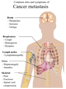 Stage 4 Cancers have metastasized to other organs that result in additional signs and symptoms as depicted in this figure.