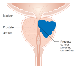 Diagram showing prostate cancer pressing on the urethra.
