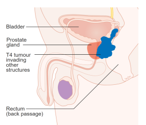 Prostate Cancer at stage T4 has spread into other body organs nearby, such as the rectum, bladder or pelvic wall.